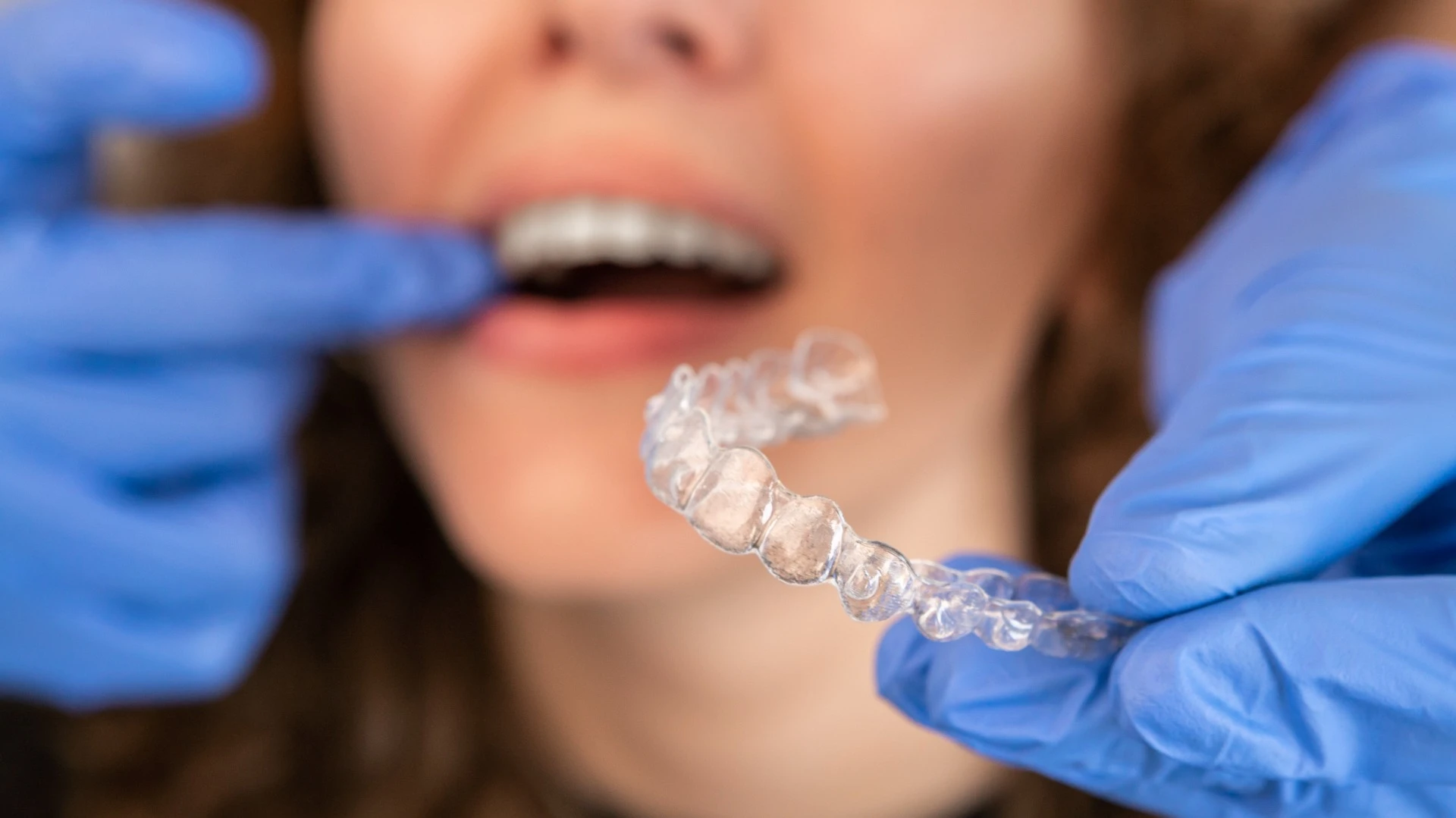 Invisalign - alineadores transparentes