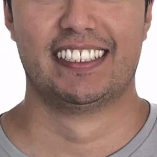 Después del tratamiento Invisalign