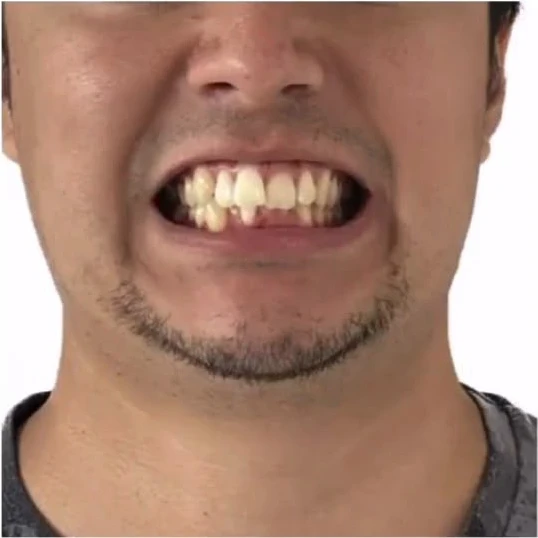 Antes del tratamiento Invisalign