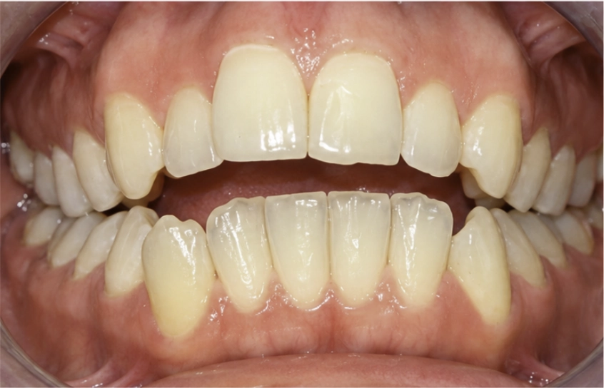 Antes del tratamiento Invisalign