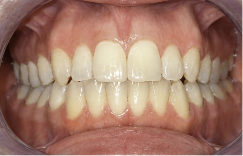Después del tratamiento Invisalign