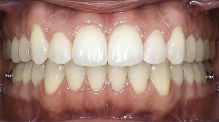 Después del tratamiento Invisalign