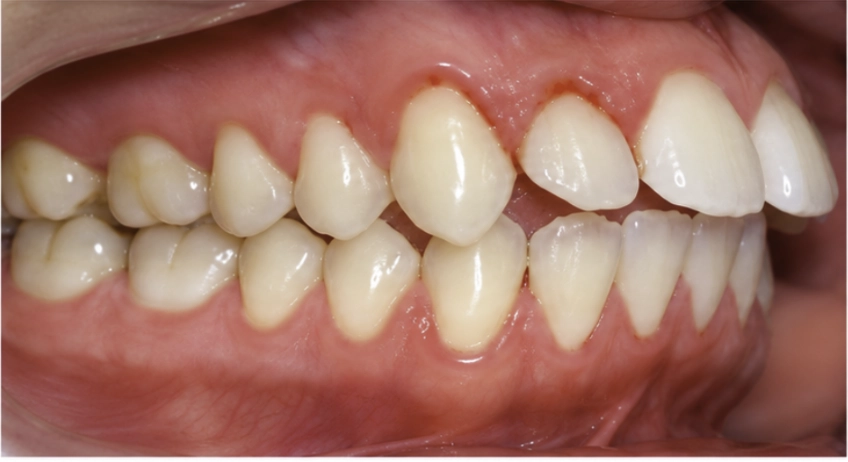 Antes del tratamiento Invisalign