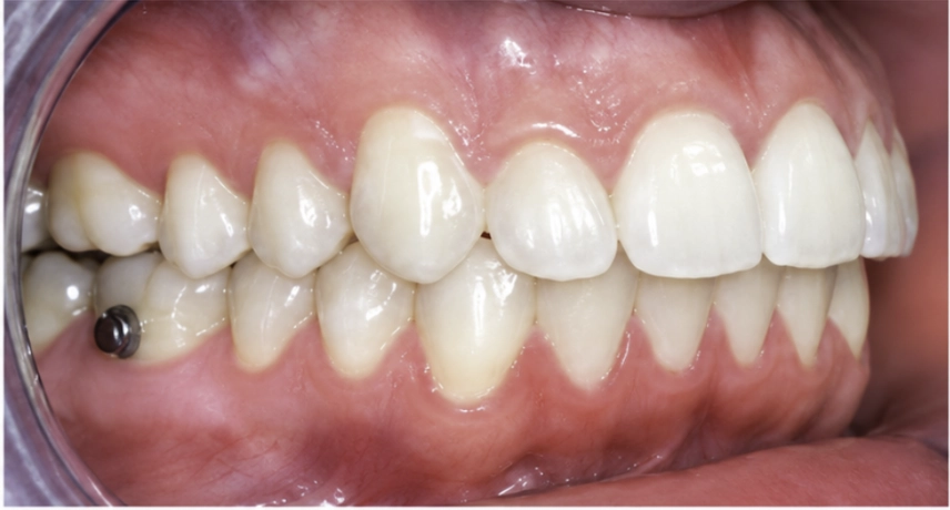 Después del tratamiento Invisalign