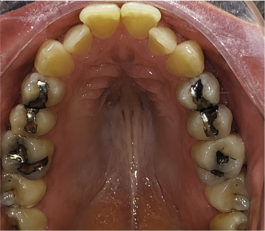 Antes del tratamiento Invisalign