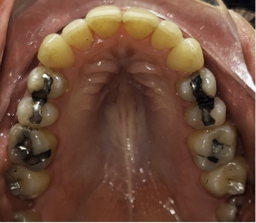 Después del tratamiento Invisalign