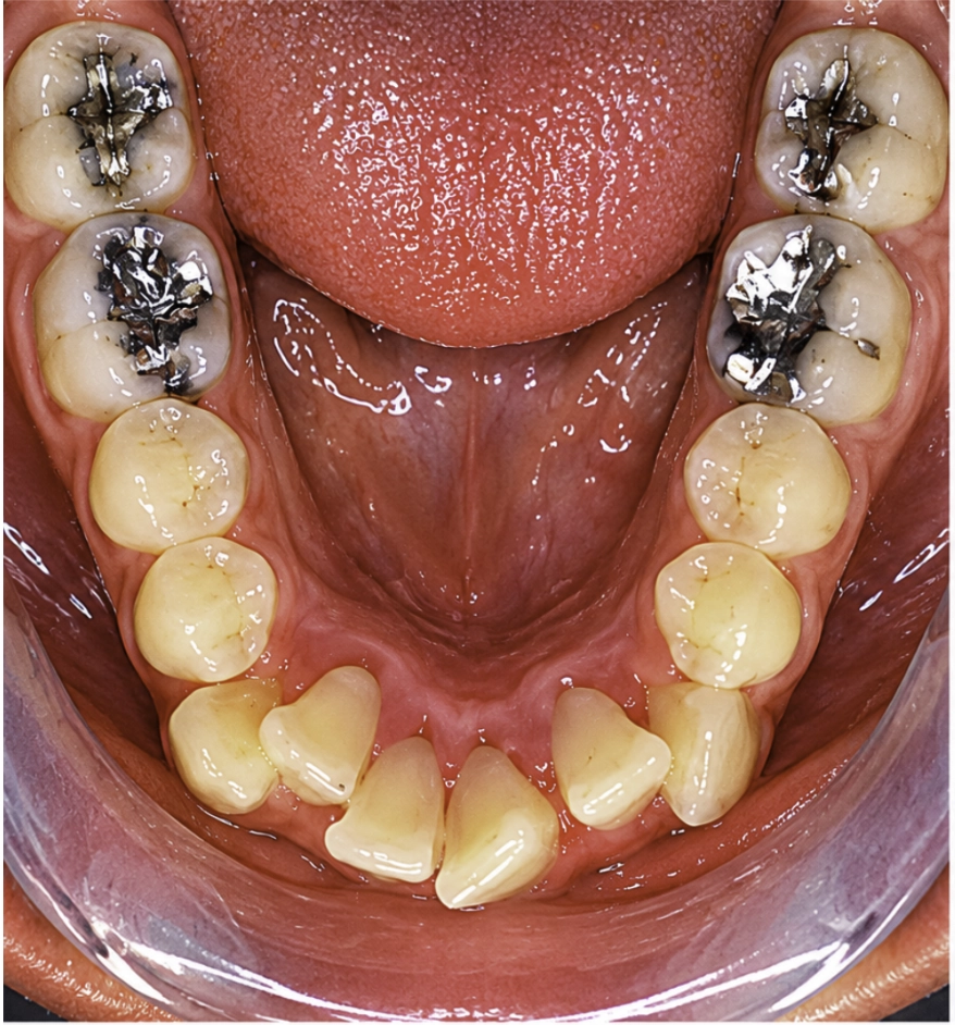 Antes del tratamiento Invisalign
