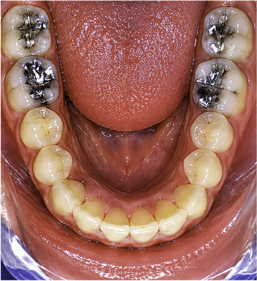 Después del tratamiento Invisalign