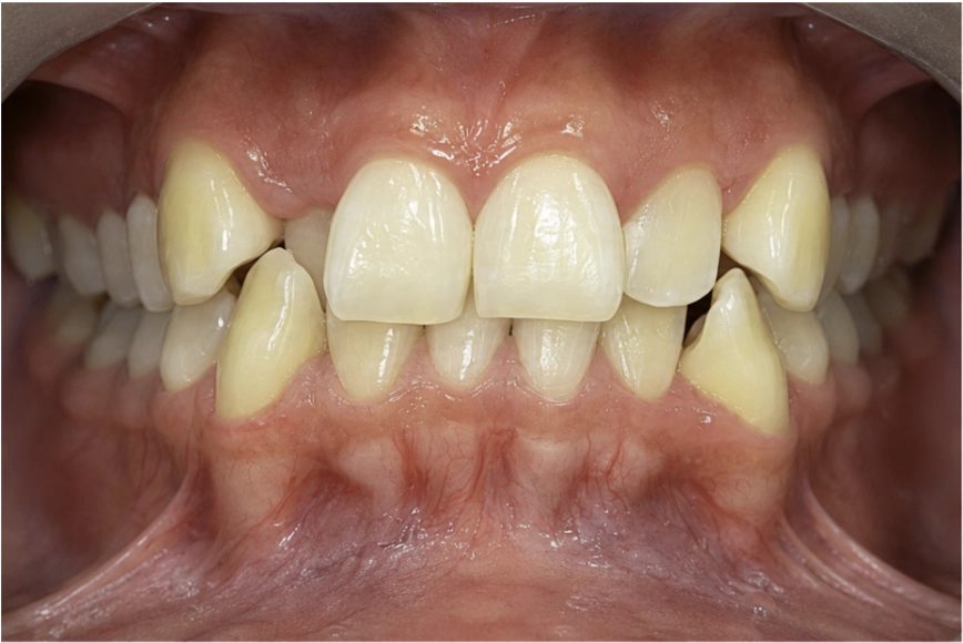 Antes del tratamiento Invisalign