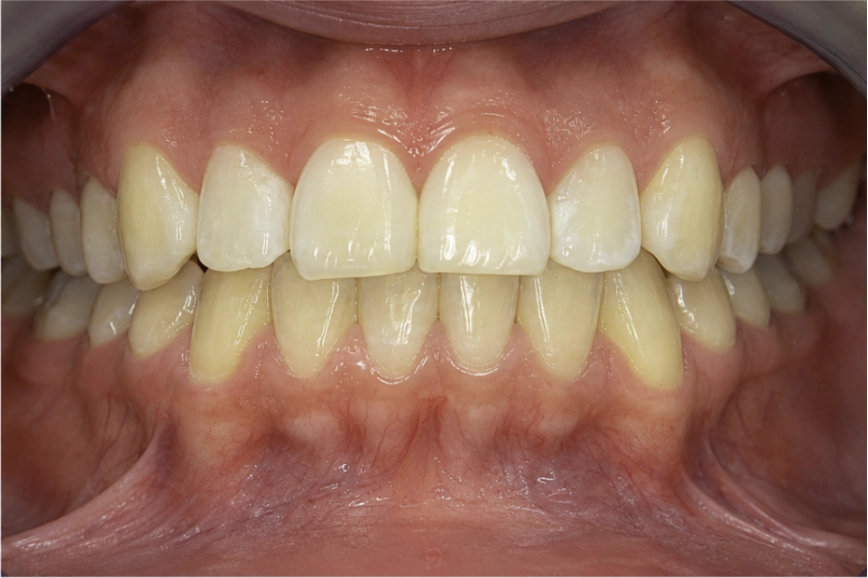 Después del tratamiento Invisalign