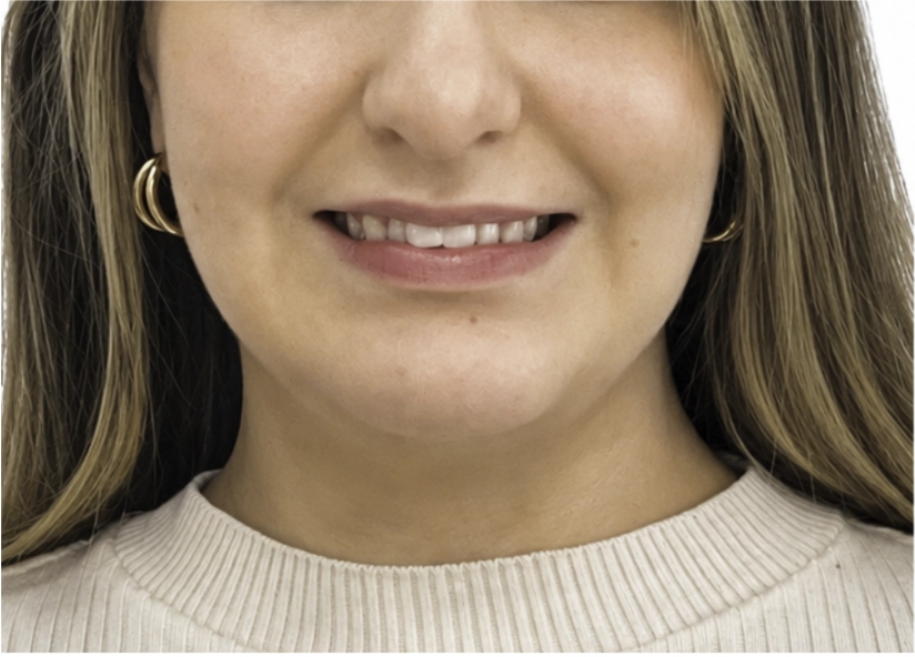Antes del tratamiento Invisalign