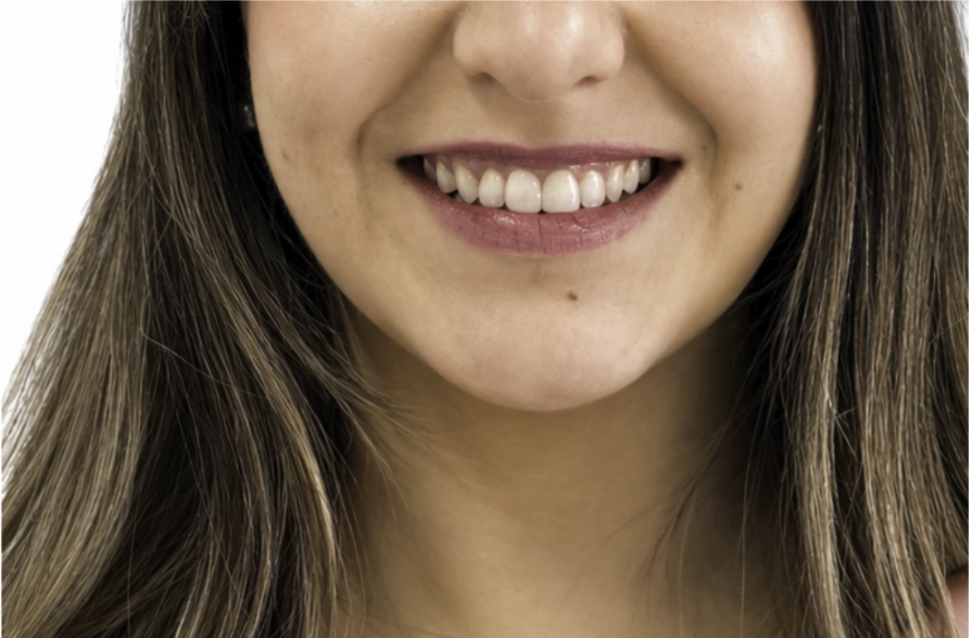 Después del tratamiento Invisalign