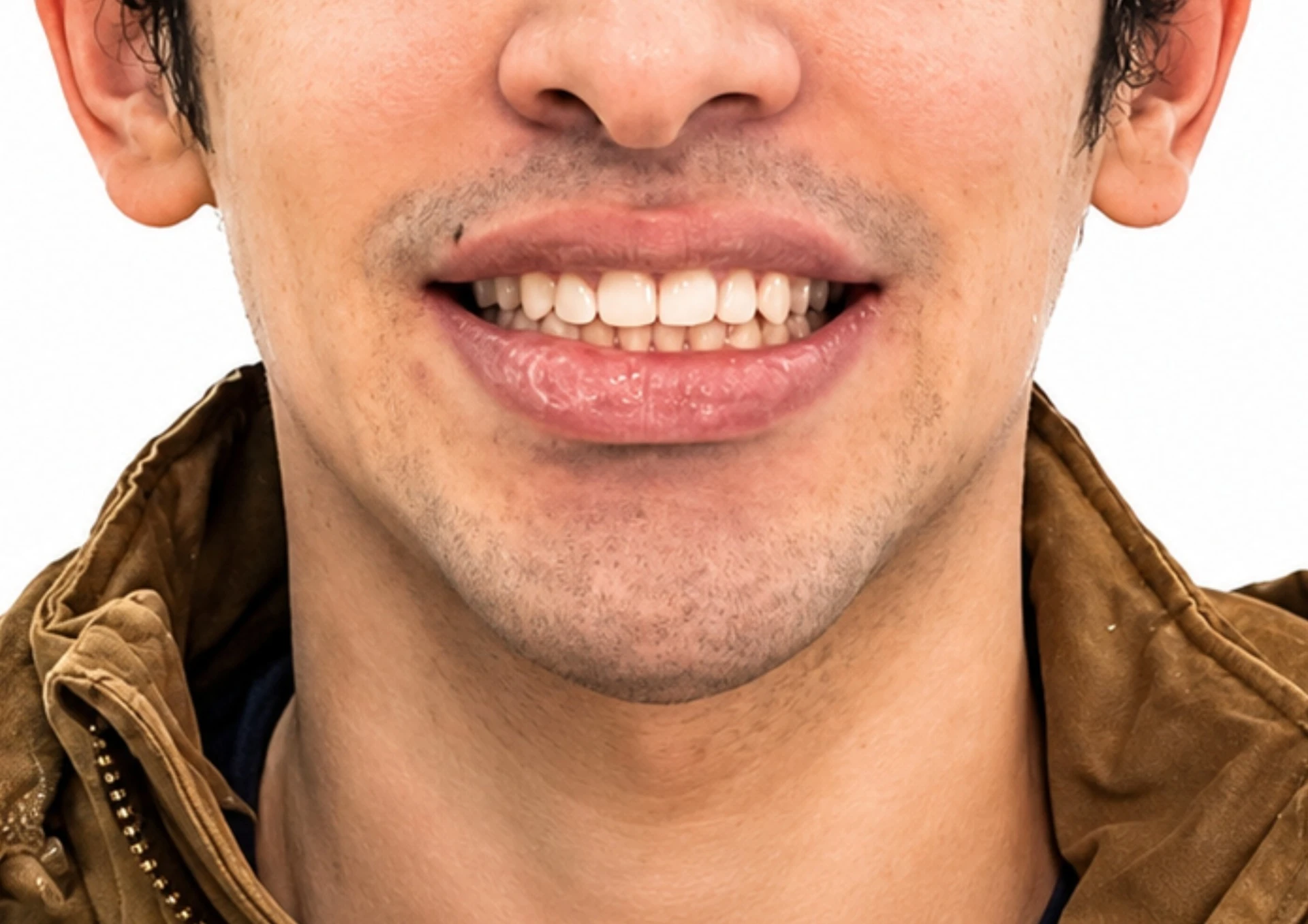 Después del tratamiento Invisalign