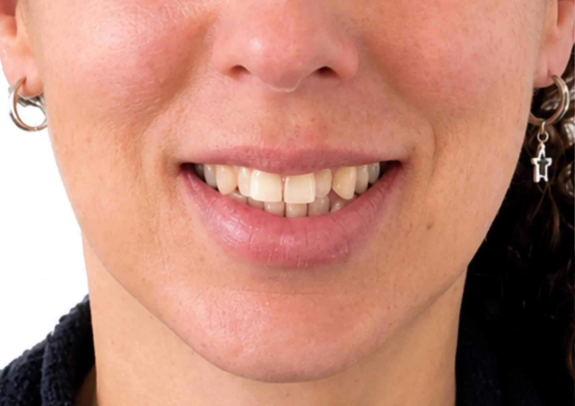 Antes del tratamiento Invisalign
