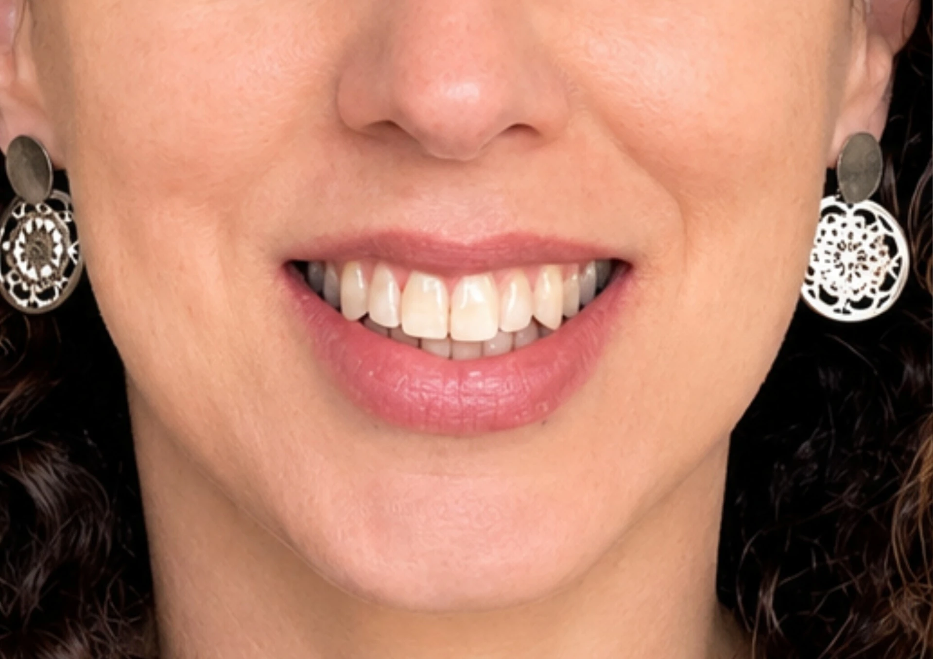 Después del tratamiento Invisalign