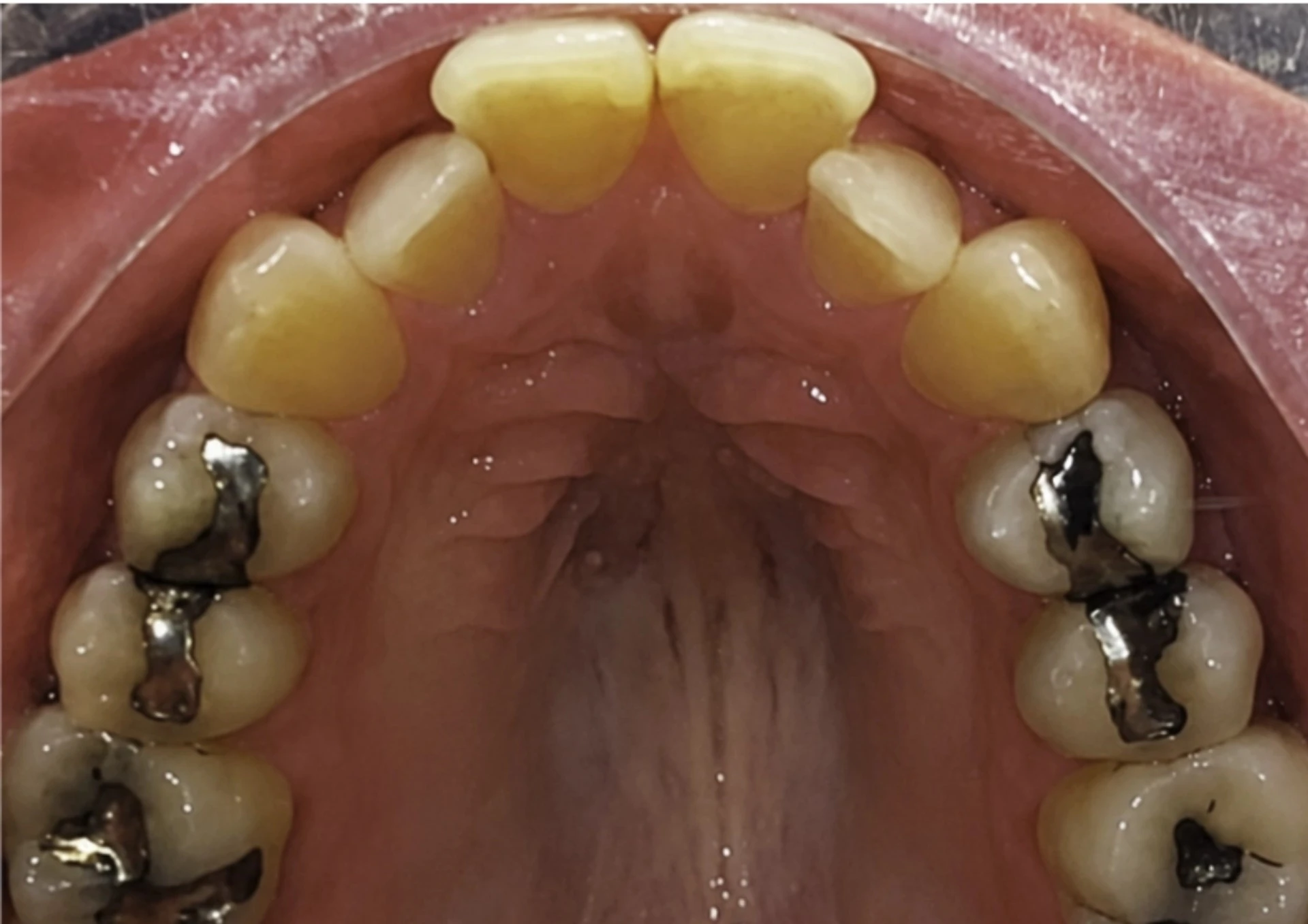 Antes del tratamiento Invisalign
