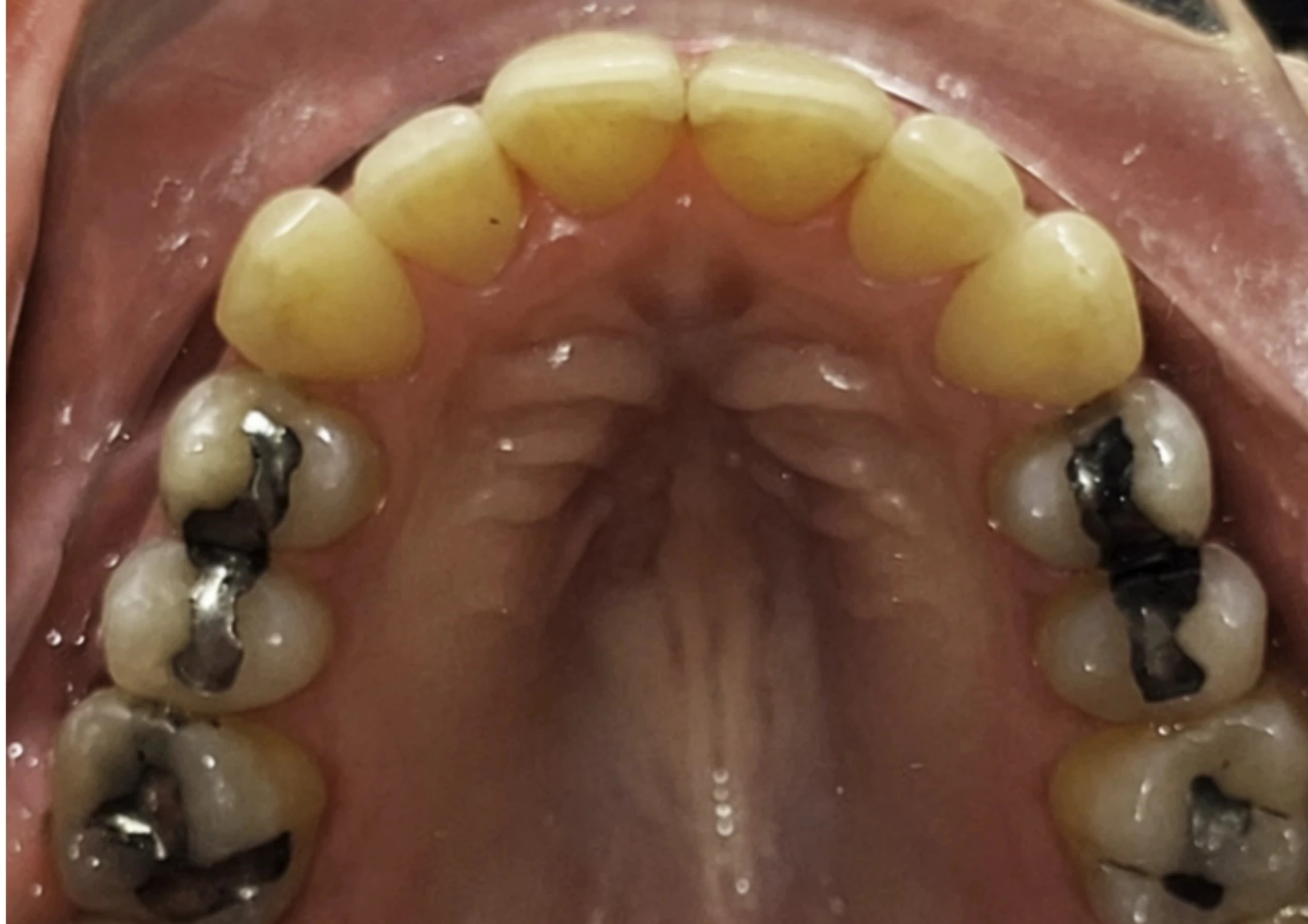Después del tratamiento Invisalign