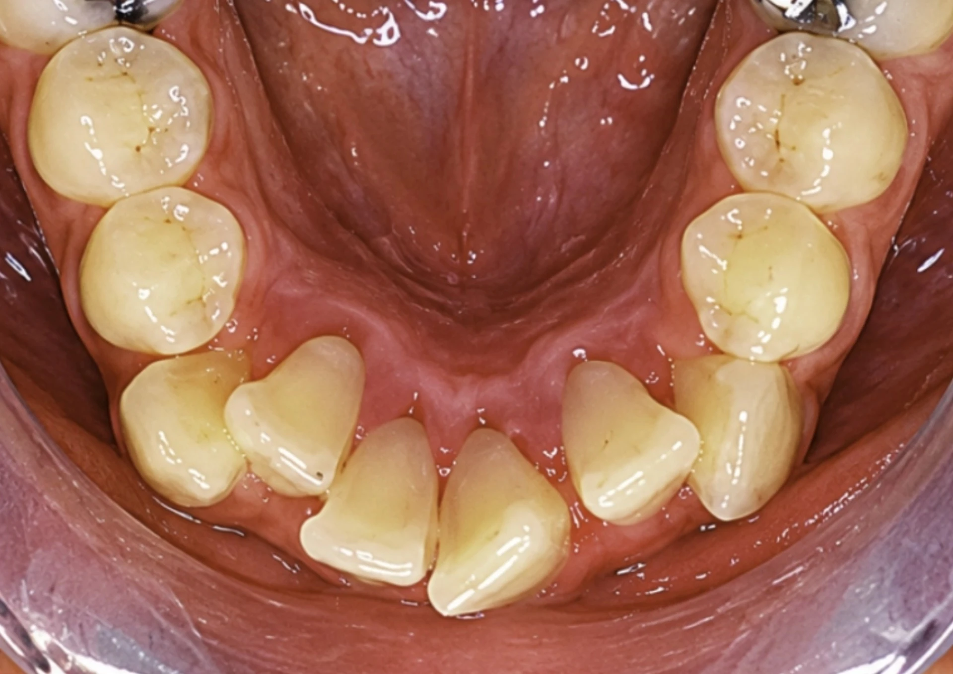 Antes del tratamiento Invisalign