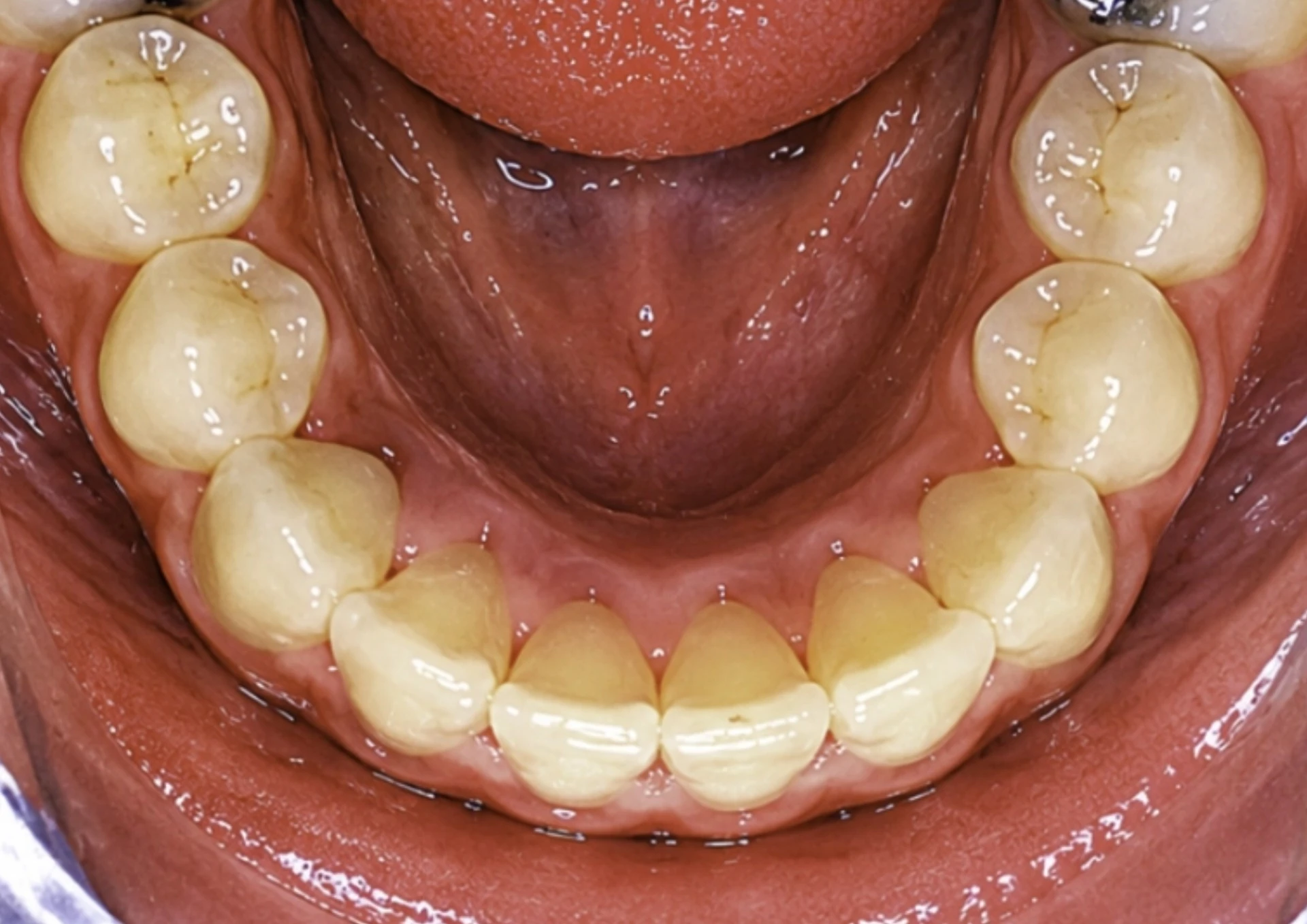 Después del tratamiento Invisalign
