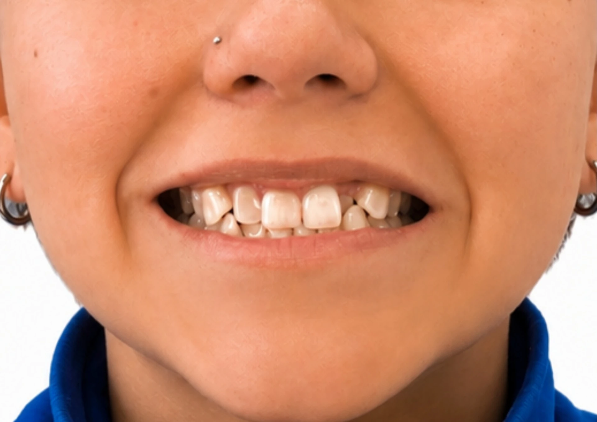 Antes del tratamiento Invisalign