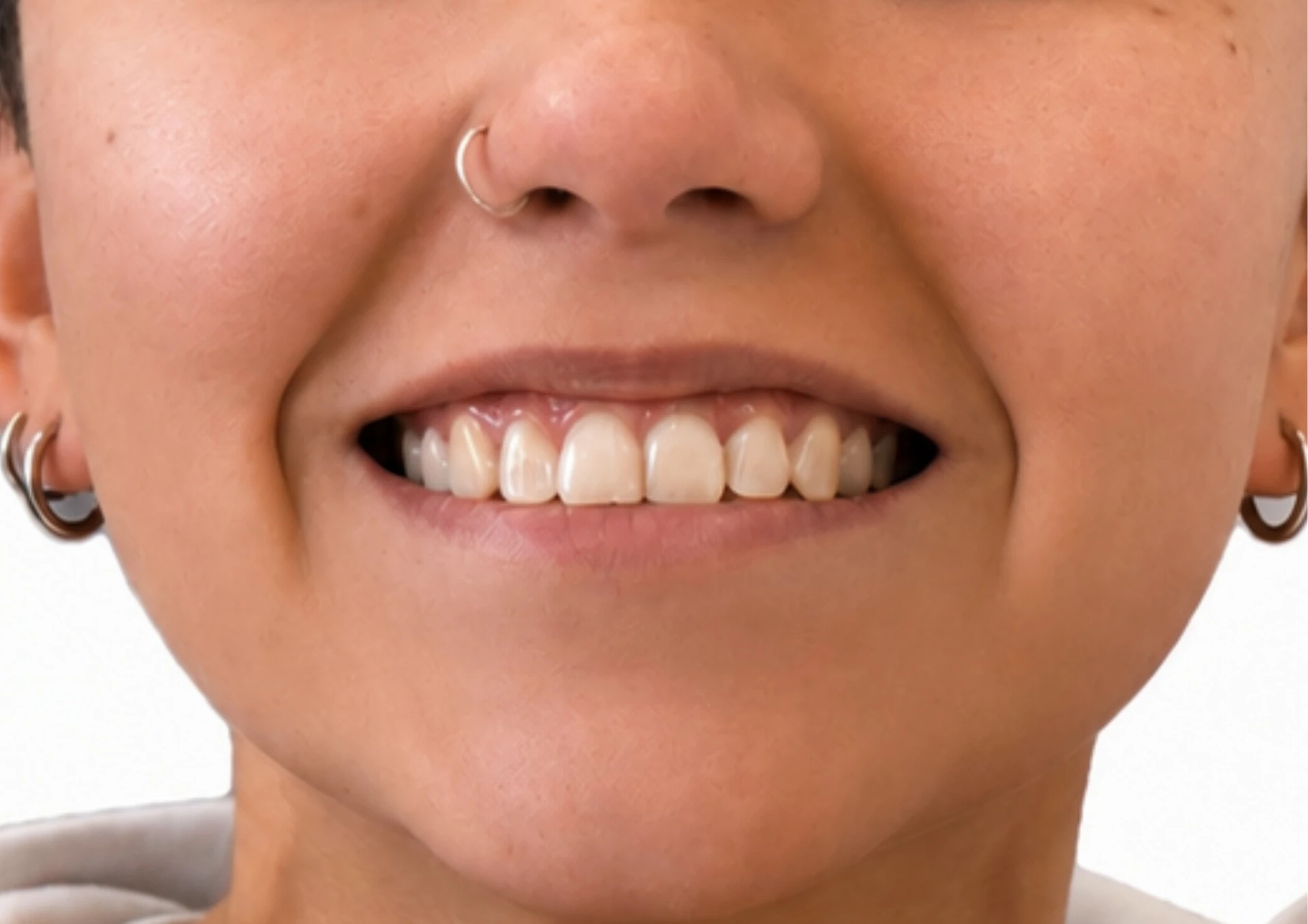 Después del tratamiento Invisalign