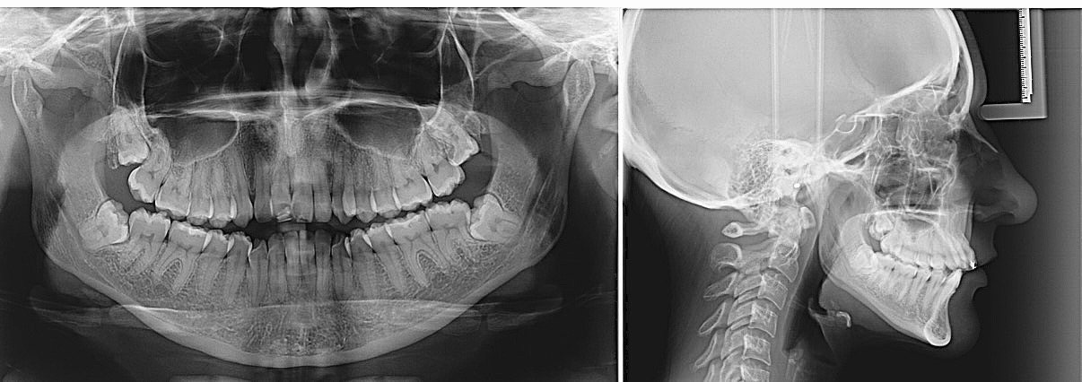 Radiografías panorámica y lateral de mandíbula mostrando dientes.