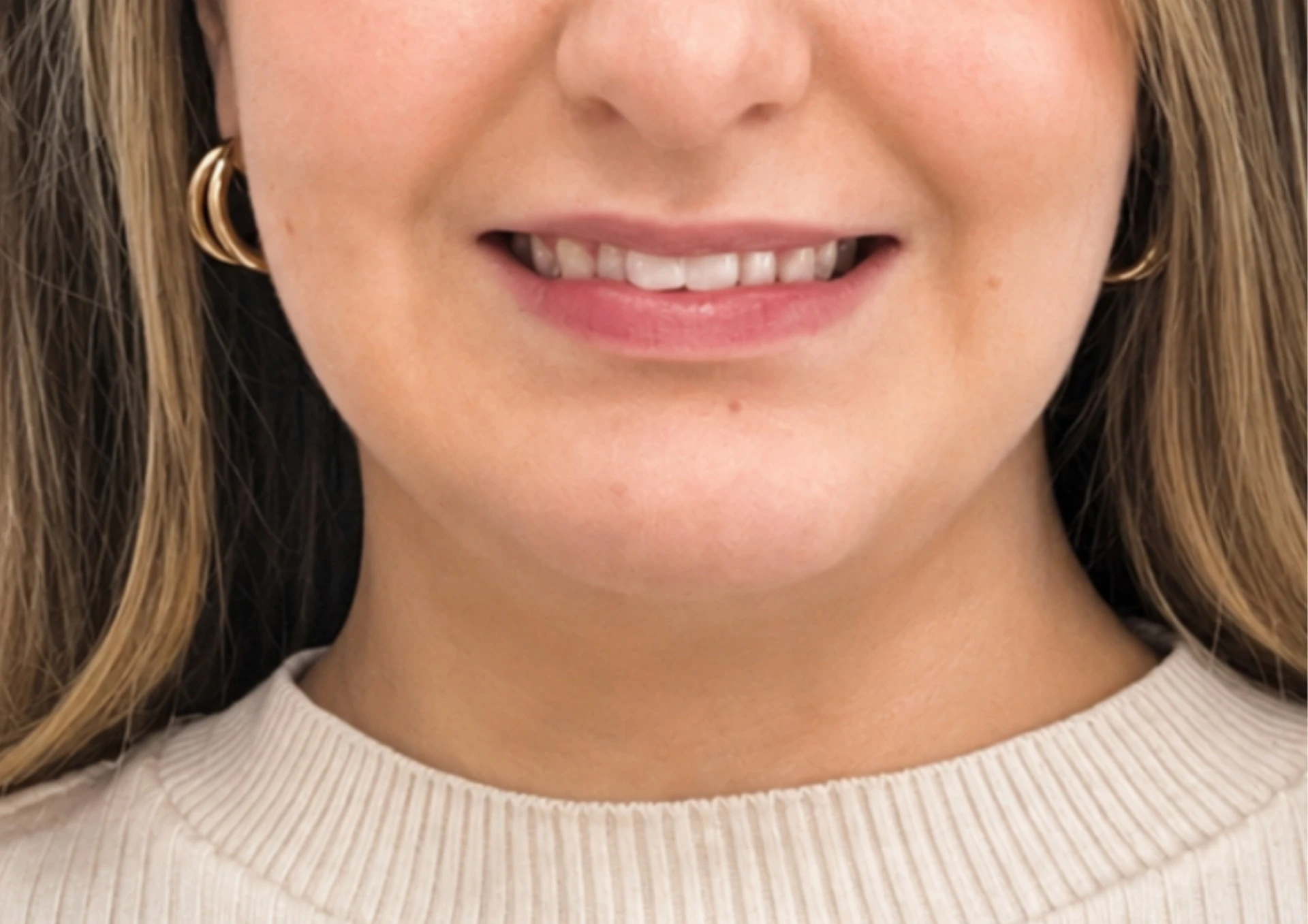Antes del tratamiento Invisalign