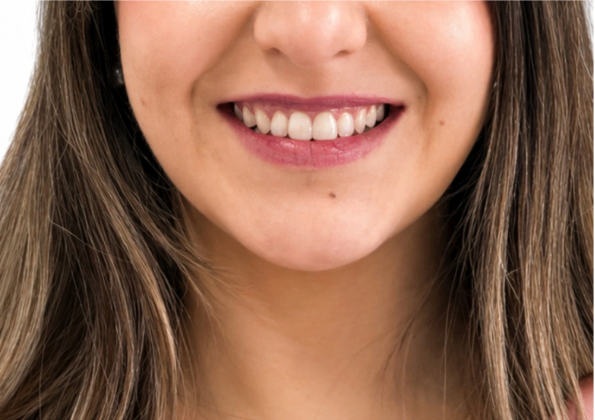 Después del tratamiento Invisalign