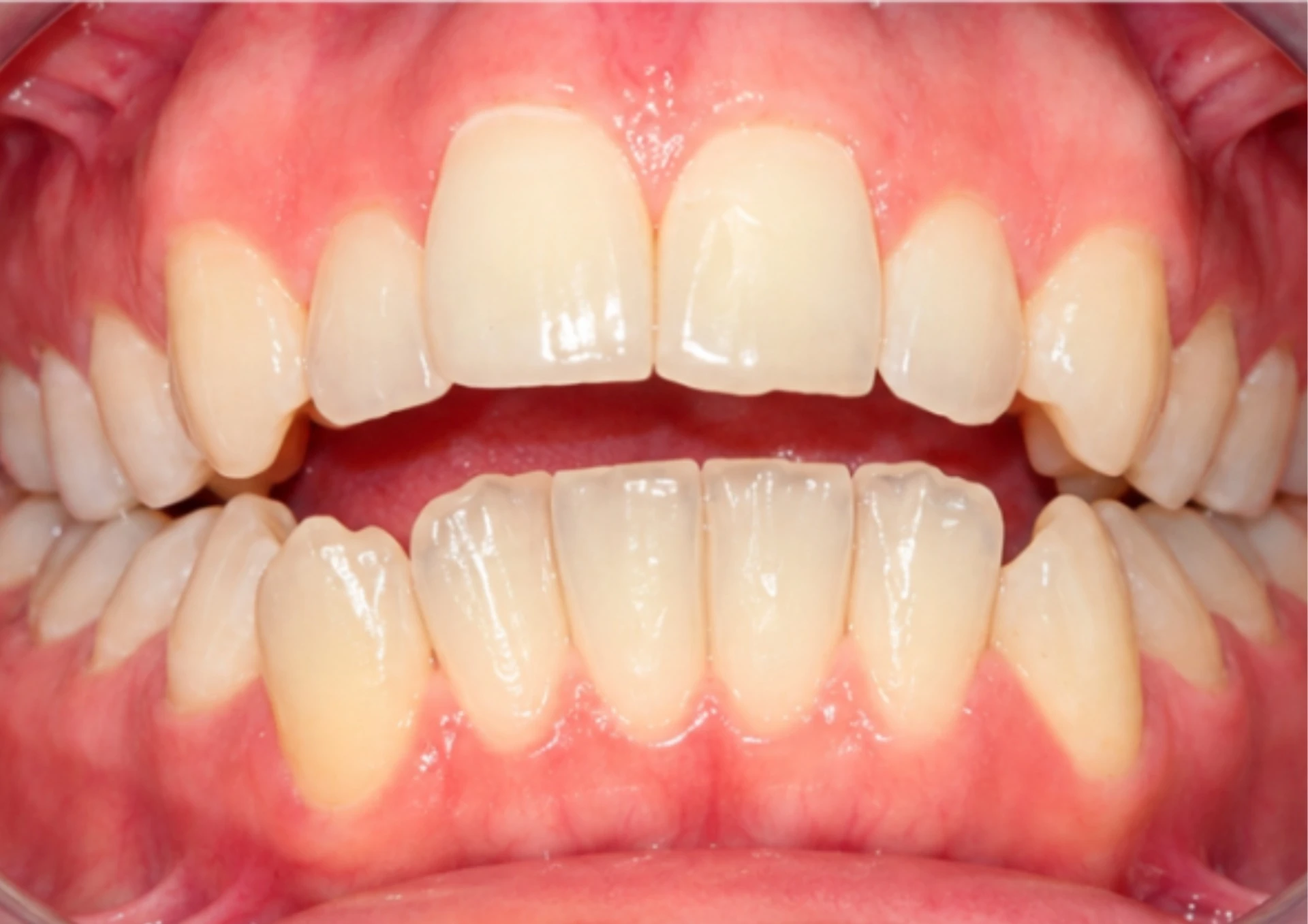Antes del tratamiento Invisalign