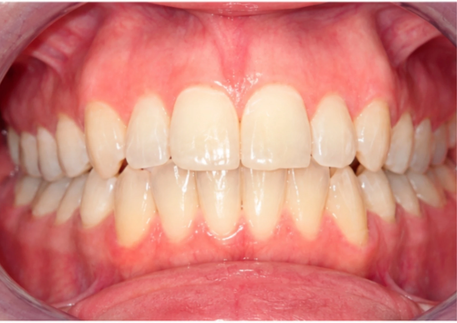 Después del tratamiento Invisalign